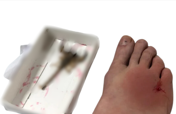 Scorpion Sting Symptoms